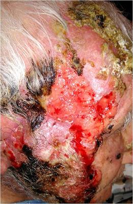 Case Report: Autoimmune Pemphigus Vulgaris in a Patient Treated With Cemiplimab for Multiple Locally Advanced Cutaneous Squamous Cell Carcinoma